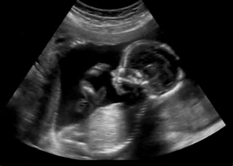 Where to Print Ultrasound Pictures: Exploring the Intersection of Technology and Nostalgia